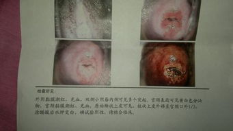 宫颈糜烂做手术多少钱 宫颈糜烂做手术大概需要多少钱