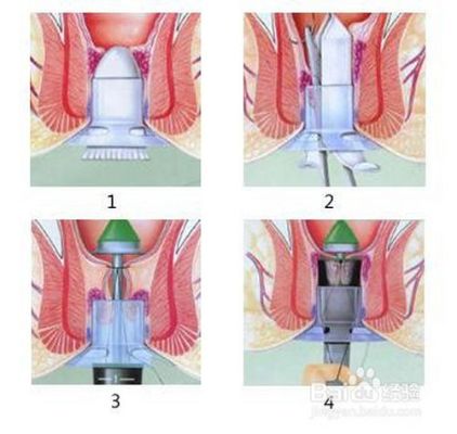 女性痔疮手术多少钱 女性痔疮手术哪种手术最好