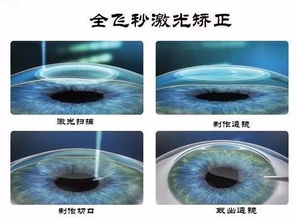 睑黄瘤激光多少钱 睑黄瘤激光多少钱一次