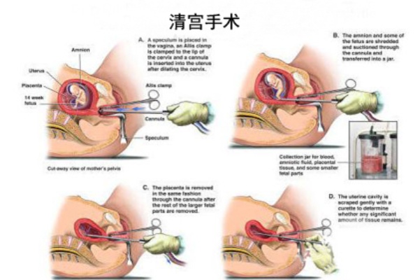 清宫多少钱啊 一般清宫大概要多少钱